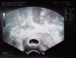 怀孕6周有孕囊没有胎芽胎心