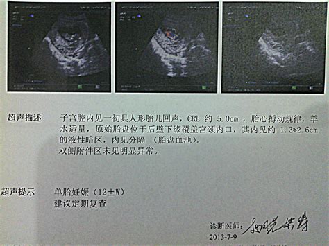 日本怀孕女性做内检