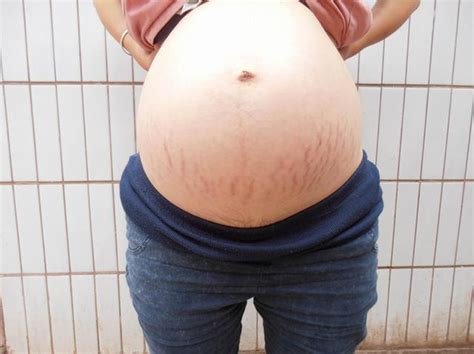 妊娠纹真的很会挑人，看看你是不是那种容易出现妊娠纹的孕妈