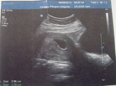 怀孕44天胎囊很小
