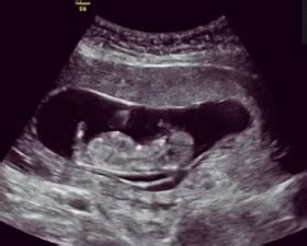 怀孕初期症状能看出男女吗