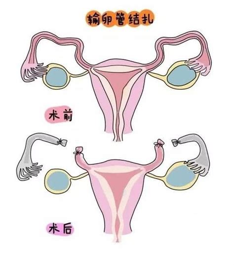 输卵管切除会老得快吗