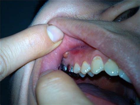 胃火引发的牙龈肿痛