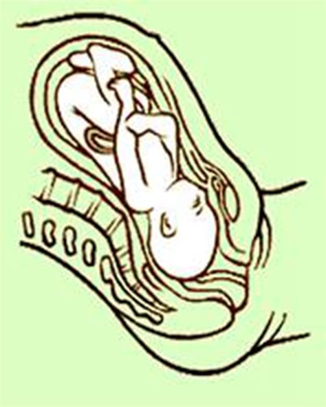 怀孕35周臀位处理方法
