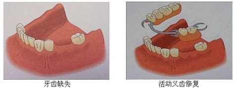 假牙分几种材料