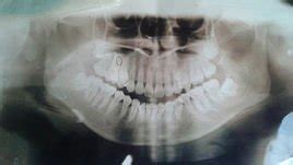 牙槽突裂手术能享受新农合报销吗
