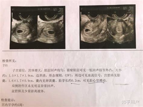 怀孕双胞胎15天b超图片真实