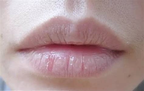 嘴唇干裂是什么原因引起的头晕
