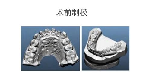 假牙的种类及价格陶瓷