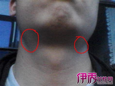 长期肿大的淋巴结就是淋巴瘤吗