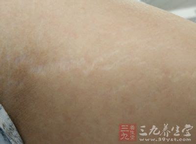 女人没生过娃大腿上有妊娠纹