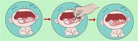 如何预防新生儿口腔感染