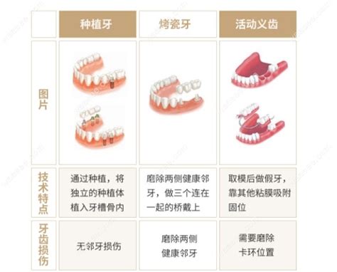 种植牙齿多少钱一颗2022年