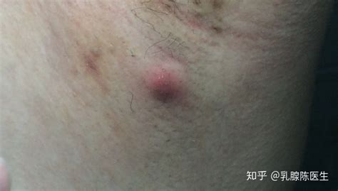 痱子粉抹在腋下疼是怎么回事