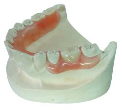 钢托活动假牙优点和缺点是什么