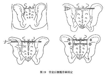 耻骨骨折卧床姿势图片