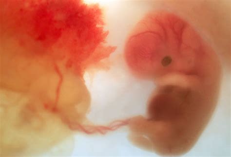 胎儿八个月心脏有缺口