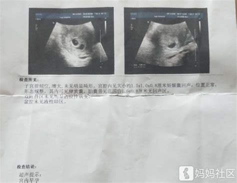 怀孕七周了有胎芽没胎心