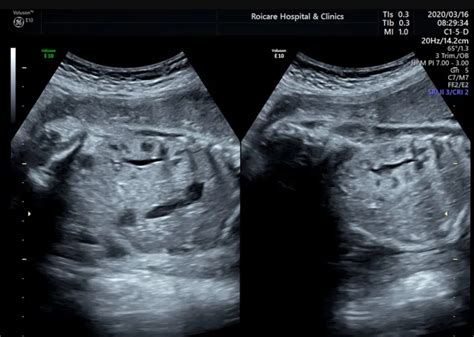 怀孕6个月左侧肾盂分离