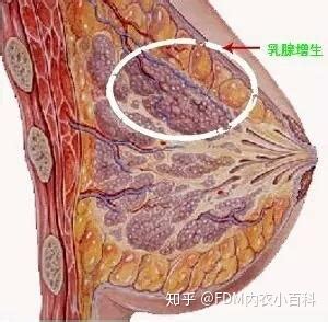 女性乳腺增生是什么引起来的