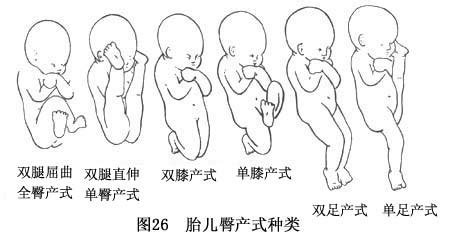 孕37周臀位注意事项及症状