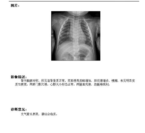 支气管炎最快解决方法