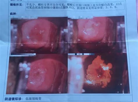 hcg800多流血像月经一样