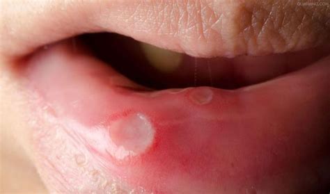 口腔溃疡敷维生素c疼死是正常的吗?