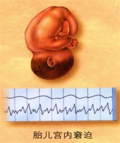 孕26周胎儿缺氧有什么表现