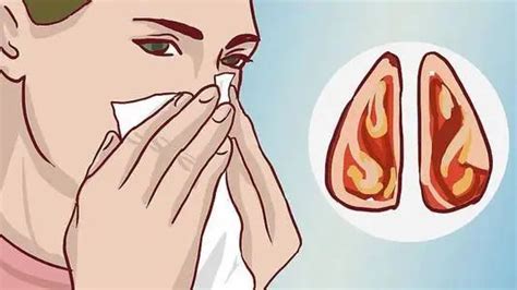 有鼻炎总是流鼻涕怎么办