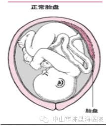 怎样预防胎儿双肾分离