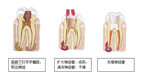 妊娠性牙龈炎怎么治疗