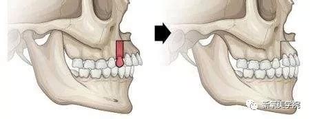 牙槽骨突出切除后遗症