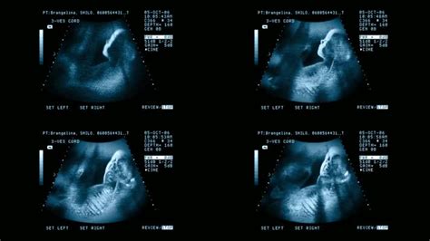 三维彩超胎儿鼻骨发育不良怎么办