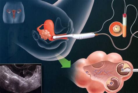 输卵管结核属于不孕不育吗