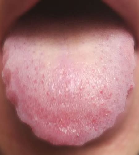 齿痕舌吃什么中成药最见效