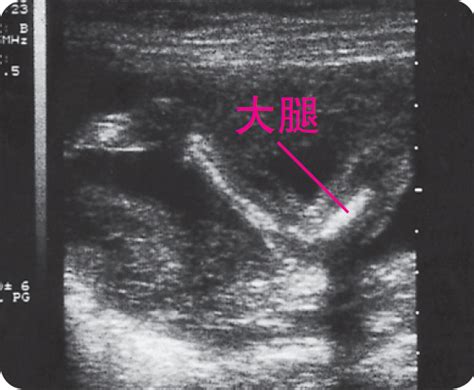 孕晚期d2聚体高会影响胎儿吗