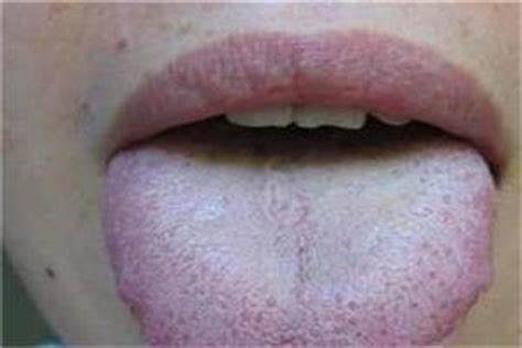 舌苔白厚是什么原因及治疗