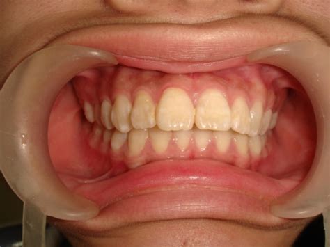 儿童牙齿保健应该注意什么