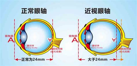 叶黄素真的可以保护眼睛的黄斑吗?