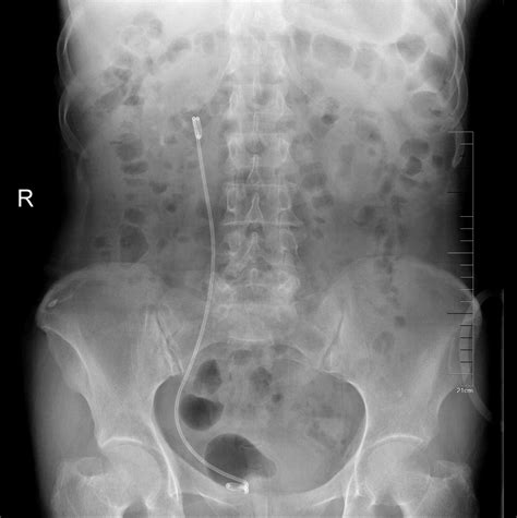 输尿管软镜取石术费用