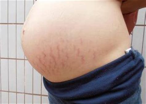 孕期怎么有效防止妊娠纹