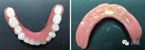 全口假牙裂缝怎么修复