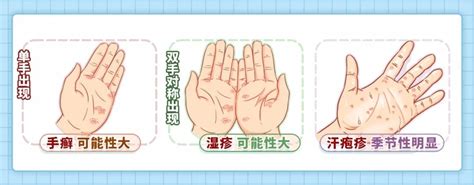 手上过敏痒怎么办