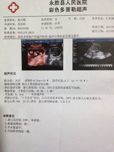 孕30周脐带绕颈一周