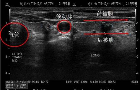 甲状腺一半恶性一半良性严重吗