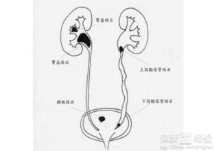 膀胱炎有哪些症状