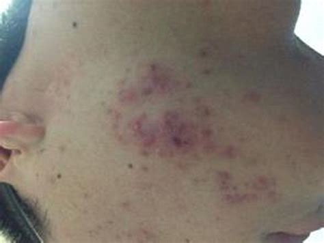 边牧细菌性皮肤病怎么治疗