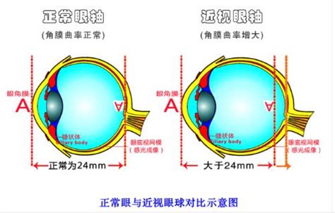 左眼近视400右眼近视150