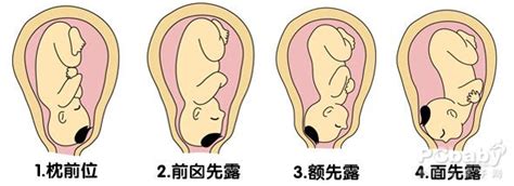 胎位不正如何纠正视频